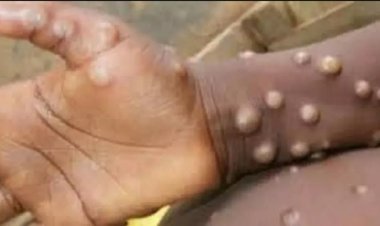 छत्तीसगढ़ में मंकीपॉक्स के संदिग्ध मरीज की टेस्ट रिपोर्ट आई निगेटिव