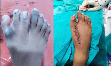पैर में सात उगलियाँ थी जूते भी नहीं पहन पाते थे, दुर्ग जिला अस्पताल में जटिल ऑपरेशन रहा सफल