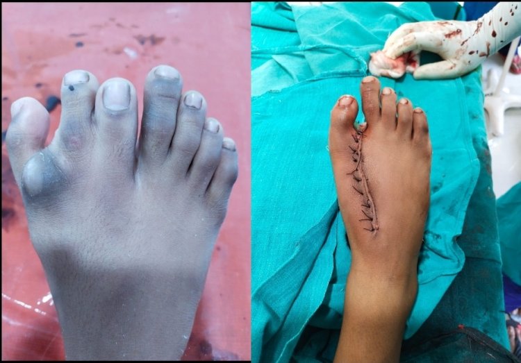 पैर में सात उगलियाँ थी जूते भी नहीं पहन पाते थे, दुर्ग जिला अस्पताल में जटिल ऑपरेशन रहा सफल