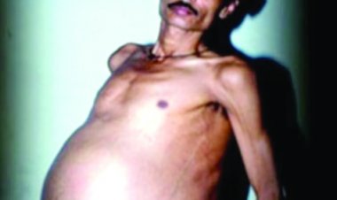 गया था ट्यूमर का इलाज कराने, 36 वर्षीय शख्स के पेट से निकला जुड़वा बच्चे