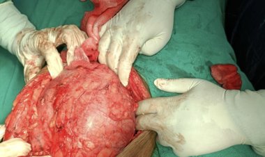 चंदूलाल अस्पताल में मरीज के जांघ से निकाला गया 3 किलो वजनी ट्यूमर, सीसीएम में एक और बड़ी उपलब्धि