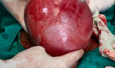 बच्चादानी से निकला 3 किलो का गोला फाइब्राइड