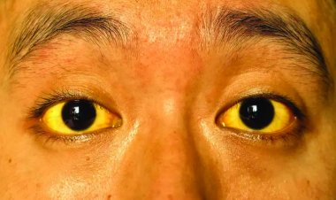 भिलाई के बाद अब अहिवारा में फैला पीलिया